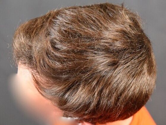 FUE Hair Restoration: Case 29 - After