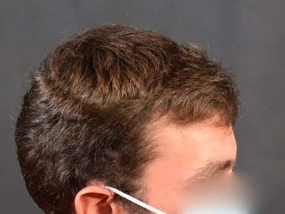 FUE Hair Restoration: Case 29 - After
