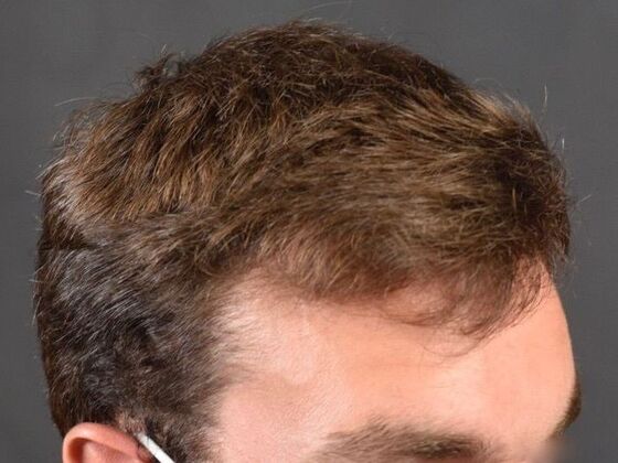 FUE Hair Restoration: Case 29 - After