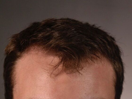 FUE Hair Restoration: Case 29 - Before