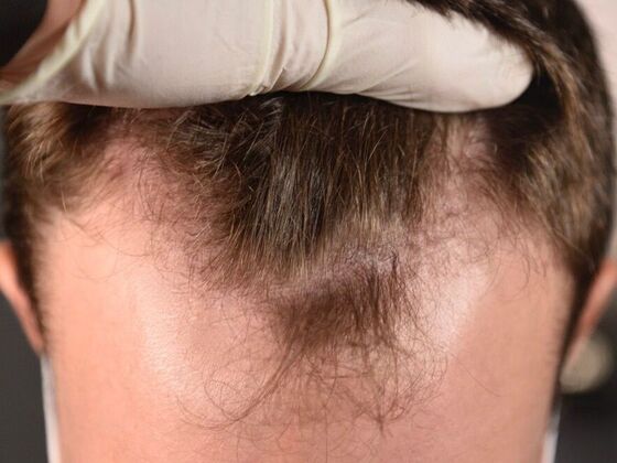 FUE Hair Restoration: Case 29 - Before