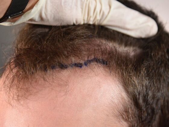FUE Hair Restoration: Case 29 - Before