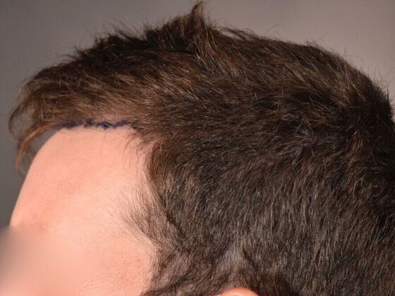 FUE Hair Restoration: Case 29 - Before