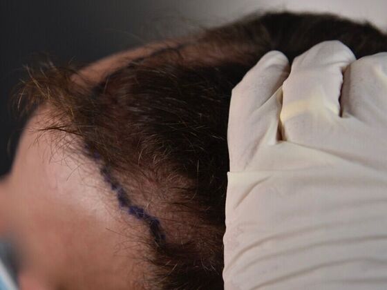 FUE Hair Restoration: Case 29 - Before