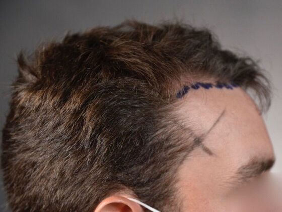 FUE Hair Restoration: Case 29 - Before