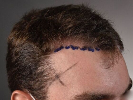 FUE Hair Restoration: Case 29 - Before