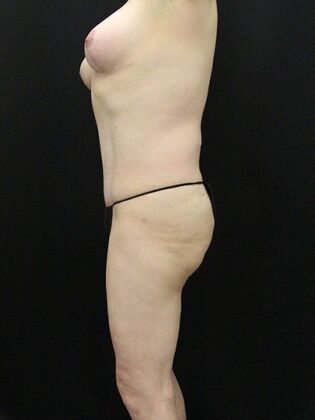 Tummy Tuck: Case 5 - After