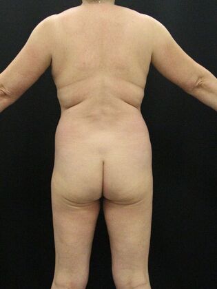 Liposuction Case 20 - Before