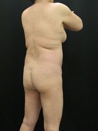 Liposuction: Case 20 - Before