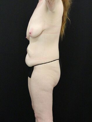 Tummy Tuck: Case 6 - Before