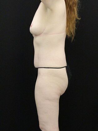 Tummy Tuck: Case 6 - After