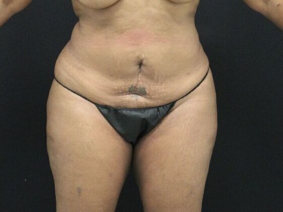 Tummy Tuck: Case 7 - Before