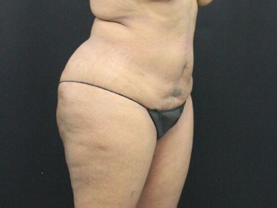 Tummy Tuck: Case 7 - Before