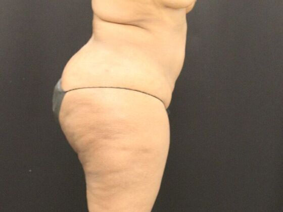 Tummy Tuck: Case 7 - Before