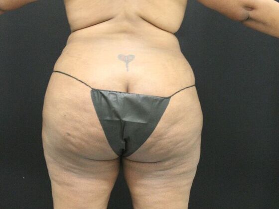 Tummy Tuck: Case 7 - Before
