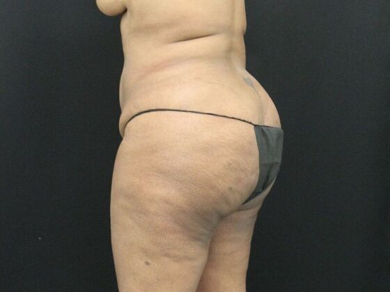 Tummy Tuck: Case 7 - Before