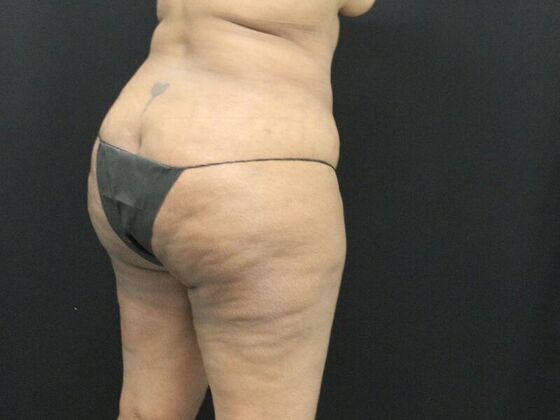 Tummy Tuck: Case 7 - Before