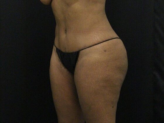 Tummy Tuck: Case 7 - After