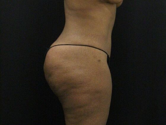 Tummy Tuck: Case 7 - After