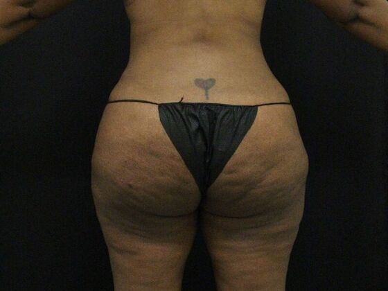 Tummy Tuck: Case 7 - After