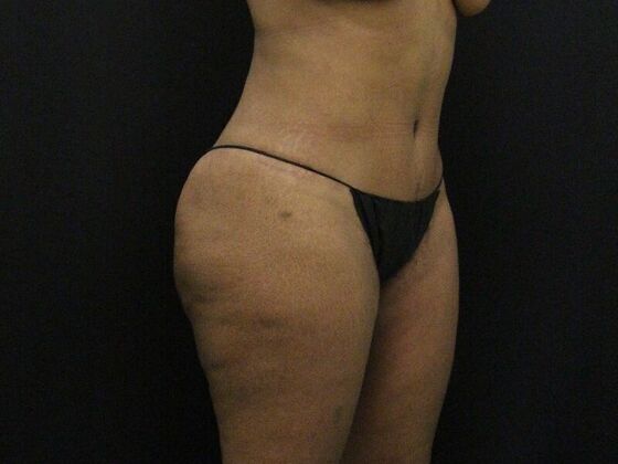 Tummy Tuck: Case 7 - After
