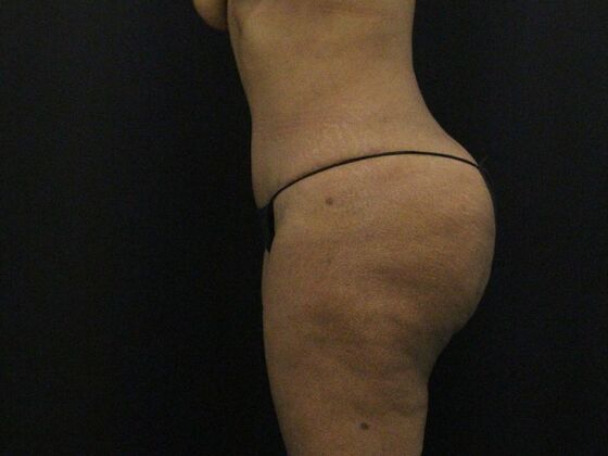 Tummy Tuck: Case 7 - After