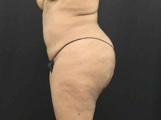 Tummy Tuck: Case 7 - Before
