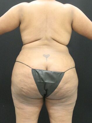 Liposuction Case 21 - Before