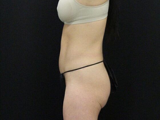 Tummy Tuck: Case 8 - After