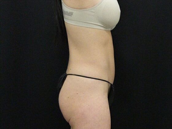 Tummy Tuck: Case 8 - After