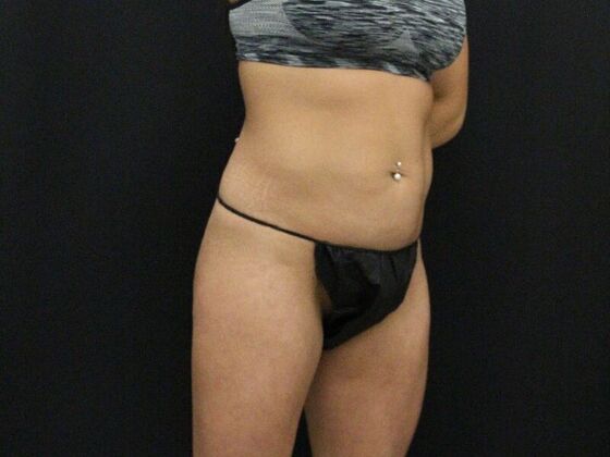 Tummy Tuck Case 8 - Before