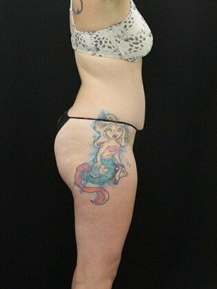 Tummy Tuck: Case 9 - After