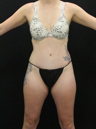 Tummy Tuck: Case 9 - After