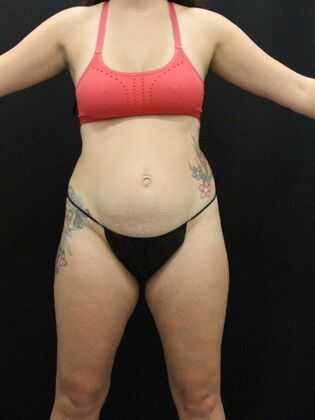 Tummy Tuck: Case 9 - Before