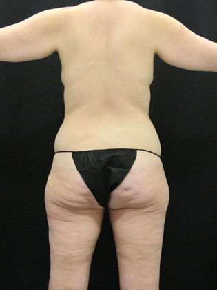 Liposuction Case 22 - Before