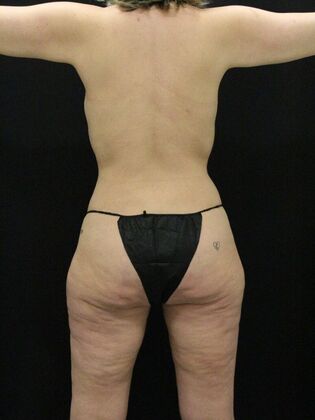 Liposuction Case 22 - After