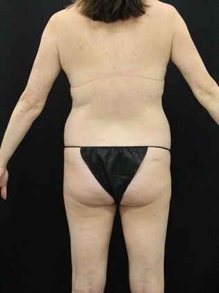 Liposuction Case 23 - Before
