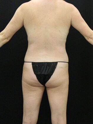 Liposuction Case 23 - After