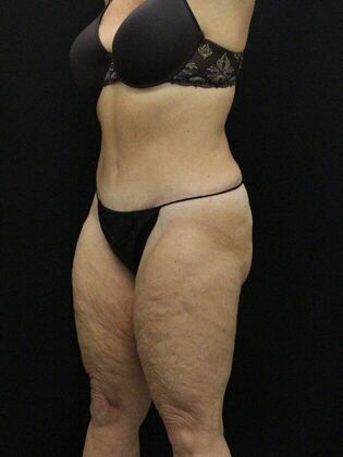 Tummy Tuck: Case 15 - After