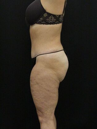 Tummy Tuck: Case 15 - Before