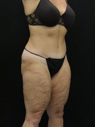 Tummy Tuck Case 15 - After