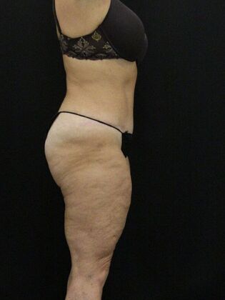 Tummy Tuck: Case 15 - After