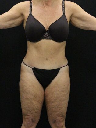 Tummy Tuck: Case 15 - After