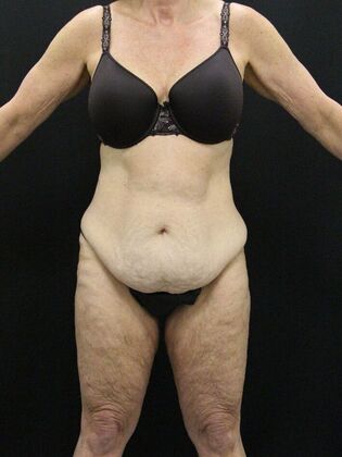 Tummy Tuck: Case 15 - Before