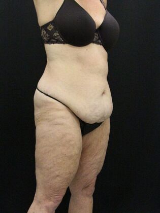 Tummy Tuck Case 15 - Before