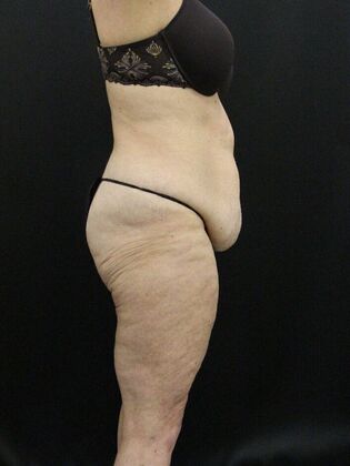 Tummy Tuck: Case 15 - Before