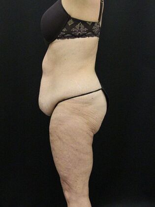 Tummy Tuck: Case 15 - After