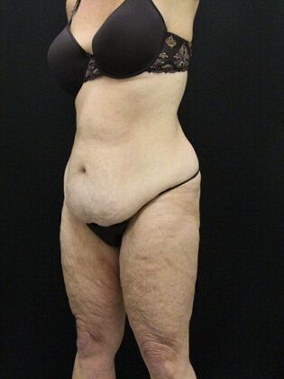 Tummy Tuck: Case 15 - Before