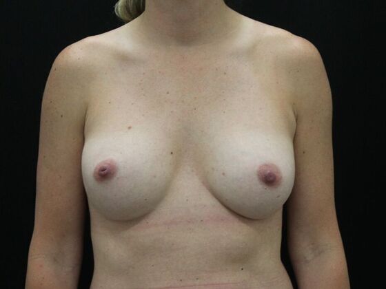 Breast Revision: Case 1 - Before