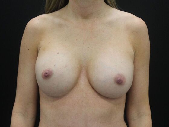 Breast Revision: Case 1 - After